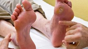 Diabetic Foot: 7 Hidden Symptoms of High Blood Sugar Level That Appear On Your Feet