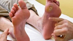 Diabetic Foot: 7 Hidden Symptoms of High Blood Sugar Level That Appear On Your Feet