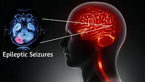 Why Are Epileptic Seizures Hard To Diagnose? Here Are The Early Signs To Look For