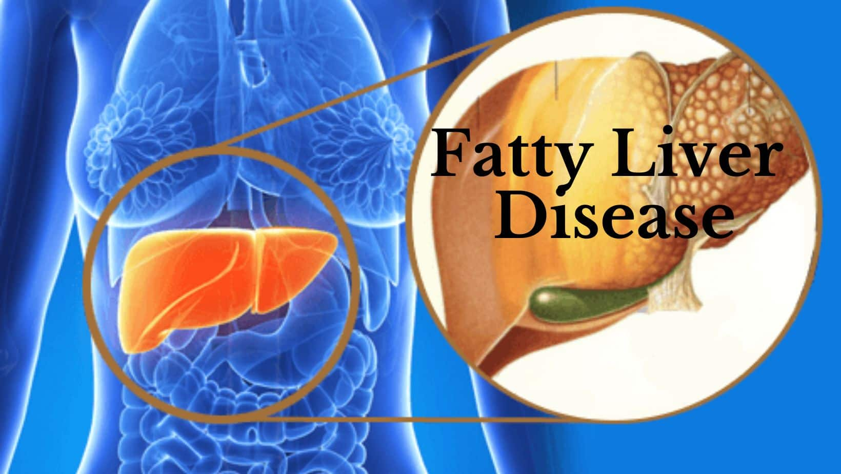 Fatty Liver Diseases: 5 Ayurvedic Home Remedies to Treat The Condition