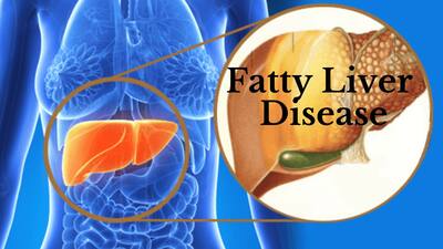 Fatty Liver Diseases: 5 Ayurvedic Home Remedies to Treat The Condition ...