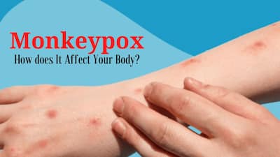 Monkeypox Infection: What Happens When You Catch The Virus? How Long ...