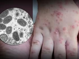 Monkeypox Cases Exceed 1000 In Canada, WHO Chief Highlights The Primary Focus Of Countries Monkeypox Cases Exceed 1000 In Canada, WHO Chief Highlights The Primary Focus Of Countries