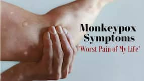Monkeypox Patient Shares First Symptoms That Appear At Night: 'Worst Pain of My Life'
