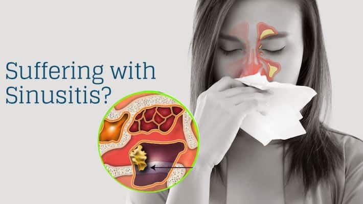 Sinus Infection: 5 Extremely Effective Home Remedies to Treat Sinusitis ...