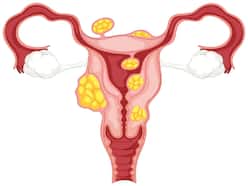 Uterine Fibroid Can Cause Infertility: Know How