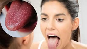 Vitamin B12 Deficiency: Silent Signs And Symptoms You Must Never Ignore