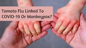 Tomato Flu Linked To COVID-19 Or Monkeypox? Check What Centre   s Advisory Says