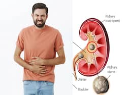 Diet High In Calcium And Potassium May Help Prevent Recurrent Kidney Stones