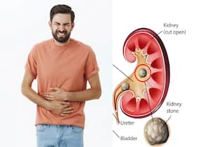 Diet High In Calcium And Potassium May Help Prevent Recurrent Kidney Stones