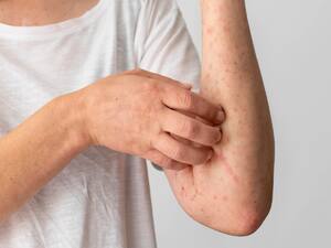 How To Prevent Scabies, Athlete's Foot, Ringworm And Other Skin Infections  During Monsoon