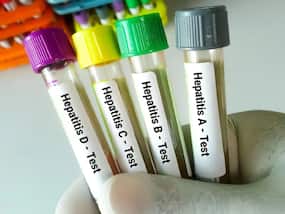Can Viral Hepatitis Cause Infertility in Men?