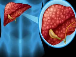 HIV-Positive Patient Develops Liver Abscess Due To Fungal Infection: Endoscopic Drainage Saves His Life