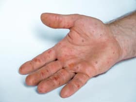 Antiviral Drug    Tecovirimat    May Be Effective In Treating Monkeypox Symptoms, Skin Lesions