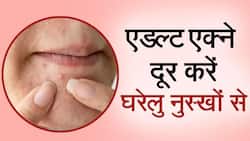 Adult Acne Remedies: जानिए 30 की उम्र में भी क्यों होते हैं मुहांसे और क्या है इसका घरेलू उपचार, Watch Video