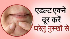 Adult Acne Remedies: जानिए 30 की उम्र में भी क्यों होते हैं मुहांसे और क्या है इसका घरेलू उपचार, Watch Video