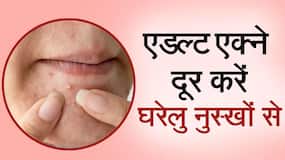Adult Acne Remedies: जानिए 30 की उम्र में भी क्यों होते हैं मुहांसे और क्या है इसका घरेलू उपचार, Watch Video