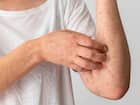 Atopic dermatitis