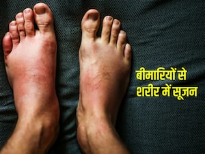 इन बीमारियों से शरीर पर आती है सूजन, जानें लक्षण