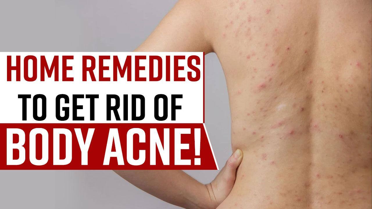 Body Acne Remedies Suffering From Body Acne Try These Home Remedies, Watch Video
