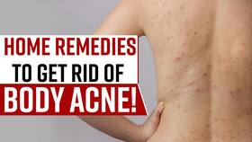 Body Acne Remedies: Suffering From Body Acne Try These Home Remedies, Watch Video