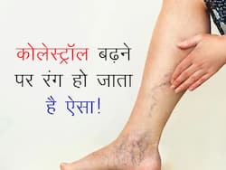 कोलेस्ट्रॉल लेवल बढ़ जाने से पैरों का रंग हो जाता है ऐसा! जानें कोलेस्ट्रॉल लेवल बढ़ने पर कैसा हो जाता है पैरों का रंग