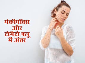 टोमैटो फ्लू और मंकीपॉक्स के लक्षण होते हैं एक जैसे, इस तरह समझें दोनों में अंतर