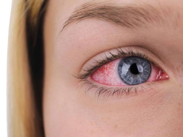 Signs Of High Cholesterol That Show Up In Your Eyes