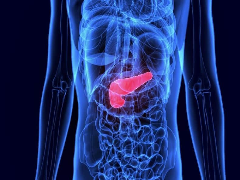 gallstones