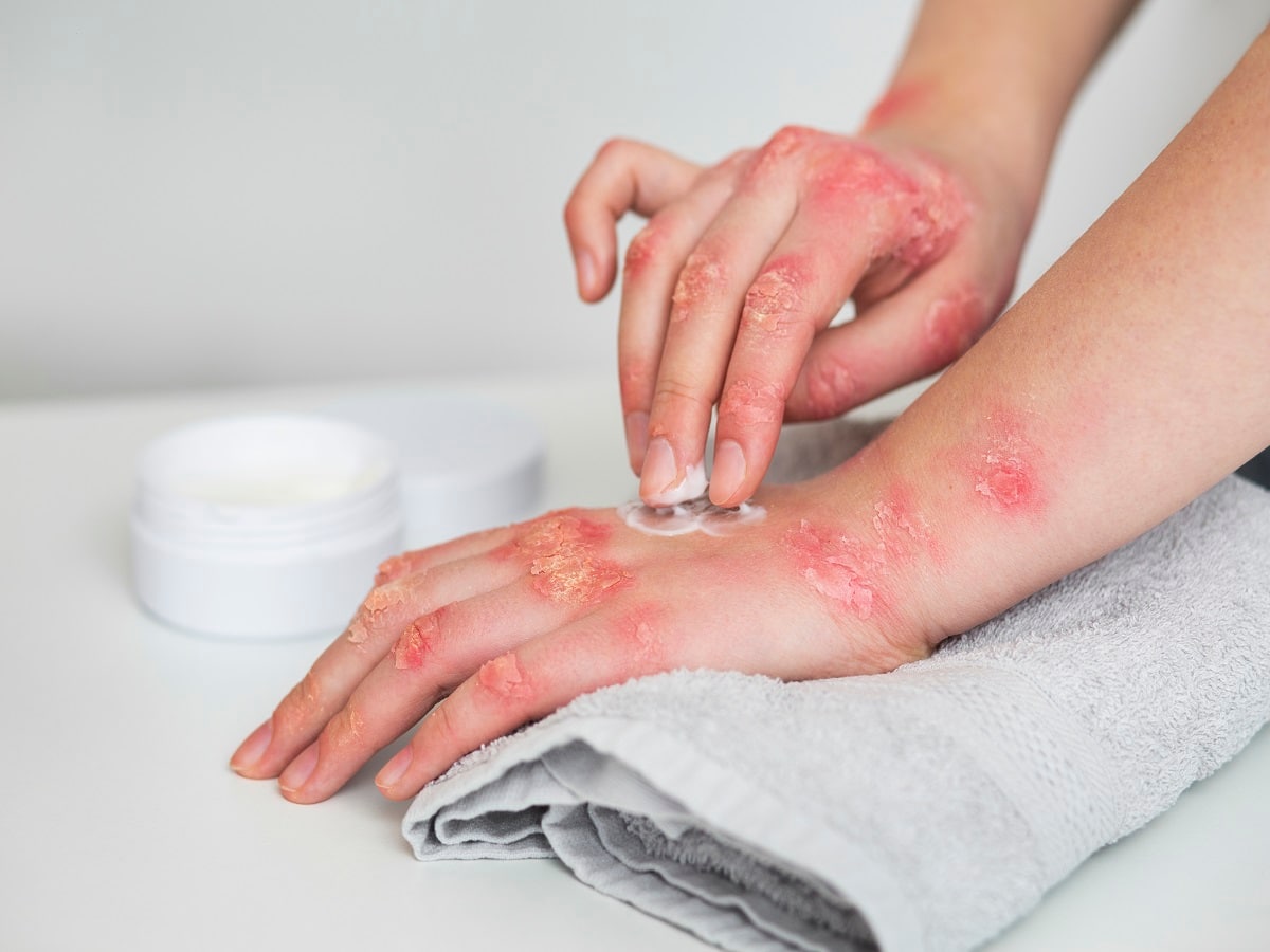 Psoriasis - Health Tips, Psoriasis Health Articles, Health News |  TheHealthSite.com