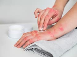 World Psoriasis Day 2022: How To Deal With Psoriasis In Daily Life?