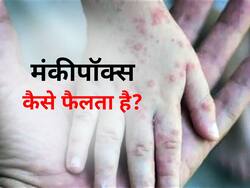 क्या पति से पत्नी और मां से बच्चे में फैल सकता है मंकीपॉक्स? एक्सपर्ट से जानें