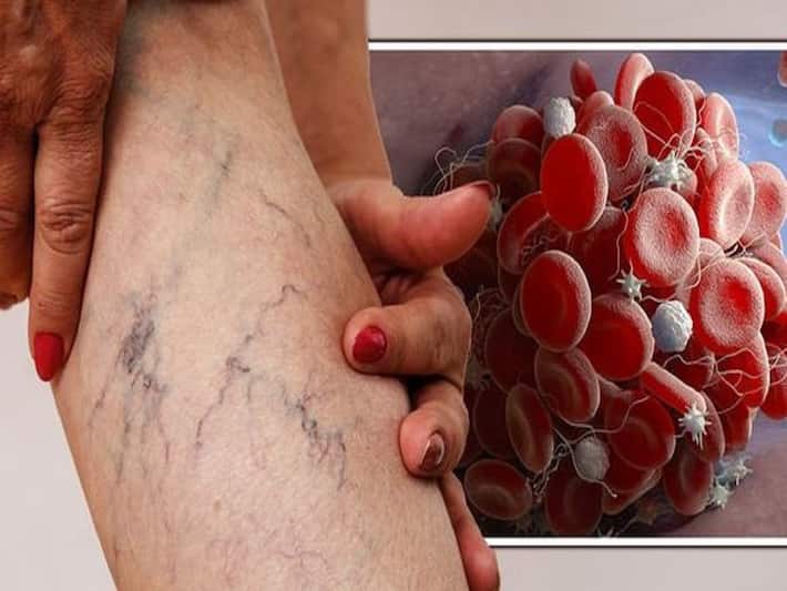 Blood Clotting Disorders - What Are Blood Clotting Disorders?