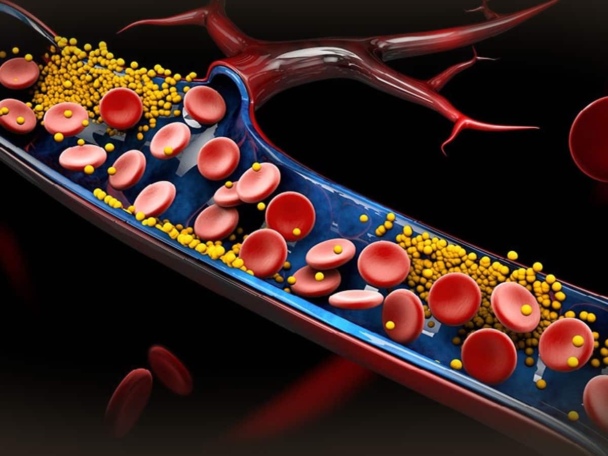 Signs Of High Cholesterol That Show Up In Your Eyes | TheHealthSite.com, image size:1200x900