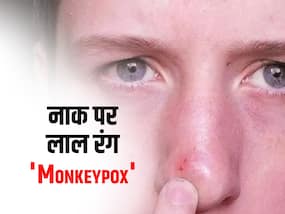 नाक पर लाल रंग के स्पॉट भी मंकीपॉक्स का हो सकता है लक्षण! 40 साल के व्यक्ति ने बताया कैसे हुआ संक्रमित