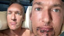 Monkeypox Patient's Post On Timeline Of Painful Symptoms of Rash Goes Viral - CHECK Photo