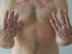 Monkeypox outbreak: दोगुनी हुई मंकीपॉक्स की रफ्तार, 96 देशों में 41 हजार से ज्यादा मामले, जानें भारत की स्थिति