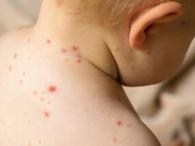 Monkeypox Virus Infects More Than 30 Children In United States