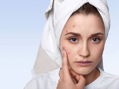 From Acne To Psoriasis, Mental Health Problems Can Lead To Chronic Skin ...