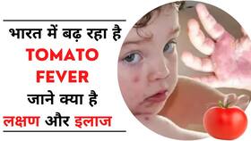 Tomato Flu: जानें क्या है Tomato Flu और कैसे है बच्चों के लिए हानिकारक, डॉक्टर से जानें, Watch Video