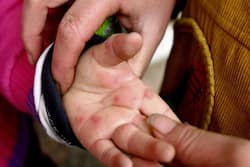 Mumbai Hospitals On Alert Amid Tomato Fever To Foreigners Can Now Apply For Booster Dose In India: Top Health Headlines Of The Day