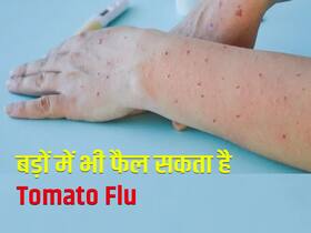 Tomato Flu को लेकर शोधकर्ताओं की चेतावनी, 'अगर नहीं रोका तो बड़ों में भी फैलेगा ये इंफेक्शन'