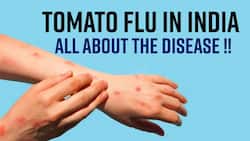 Tomato Fever: Tomato Flu Spread In Children, Rashes On The Skin And Many Such Symptoms Occur, To Know The Treatment, Watch Video