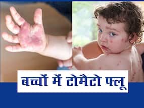 बच्चों में टोमैटो फ्लू का खतरा बड़ों से ज्यादा, जानें इस बीमारी से बचने के लिए कैसे बढ़ाएं बच्चों की इम्यूनिटी