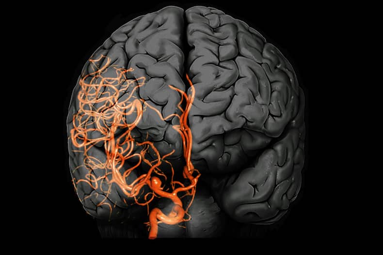Brain Aneurysm: 9 Unusual Symptoms Of This Condition That Can Lead To Hemorrhagic Stroke