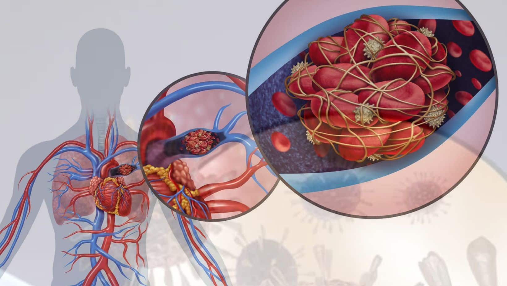 LifeThreatening Blood Clots For Over 49 Weeks PostCOVID Recovery New