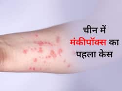 चीन में मंकीपॉक्स का पहला मामला आया सामने, स्वास्थ्य अधिकारियों ने दिया विदेशियो को ना छूने का आदेश