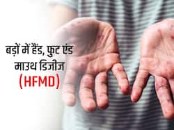 Hand Foot Mouth Disease: बच्चों की तुलना बड़ों में अलग होती है ये बीमारी, पूरे शरीर में हो सकते हैं खुजलीदार दाने