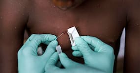 Monkeypox Outbreak Going Out of Control? Global Cases Top 50,000; WHO Lists Three Things To Eliminate Disease