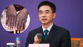 'Do Not Touch The Foreigners,' Chinese Officials Warn As Country Confirms First Monkeypox Case